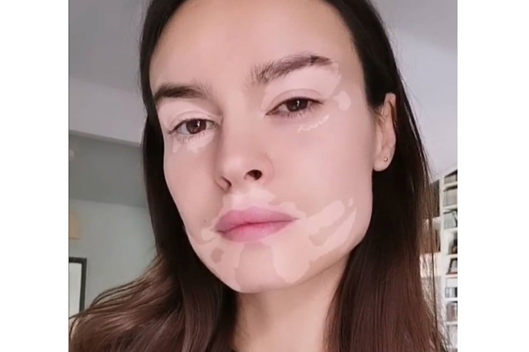 Kasia Smutniak stworzyła filtr na Instagramie, który wspiera osoby chorujące ba bielactwo