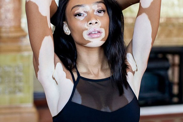 Modelka z bielactwem Winnie Harlow została nową twarzą Converse