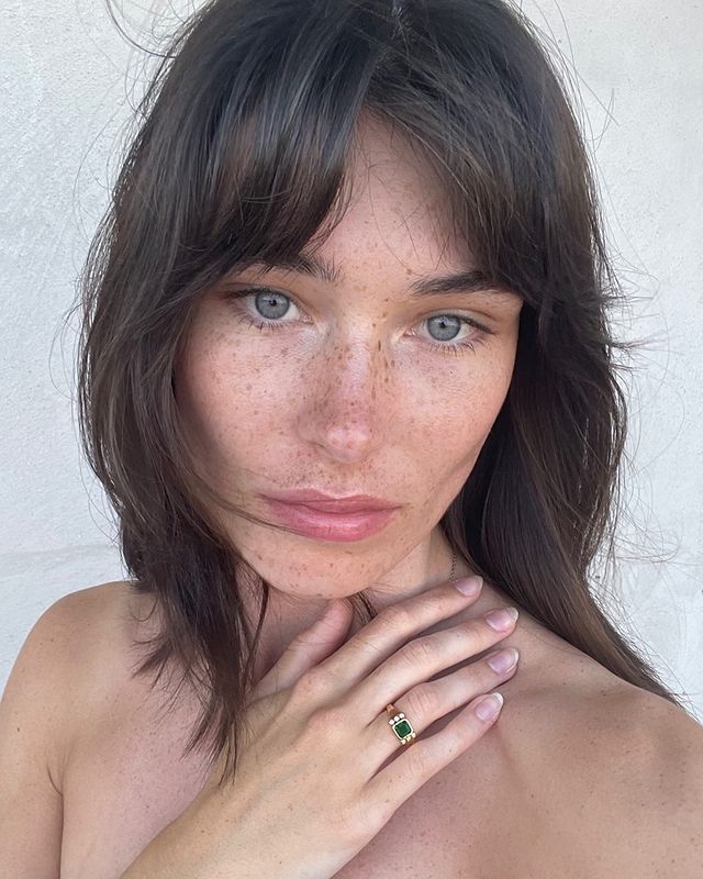 Melasma - jak pozbyć się przebarwień na twarzy?