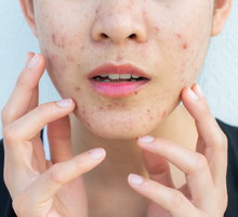 Close-up of worrying woman half face with problems of acne inflammation (Papule and Pustule) on her face.