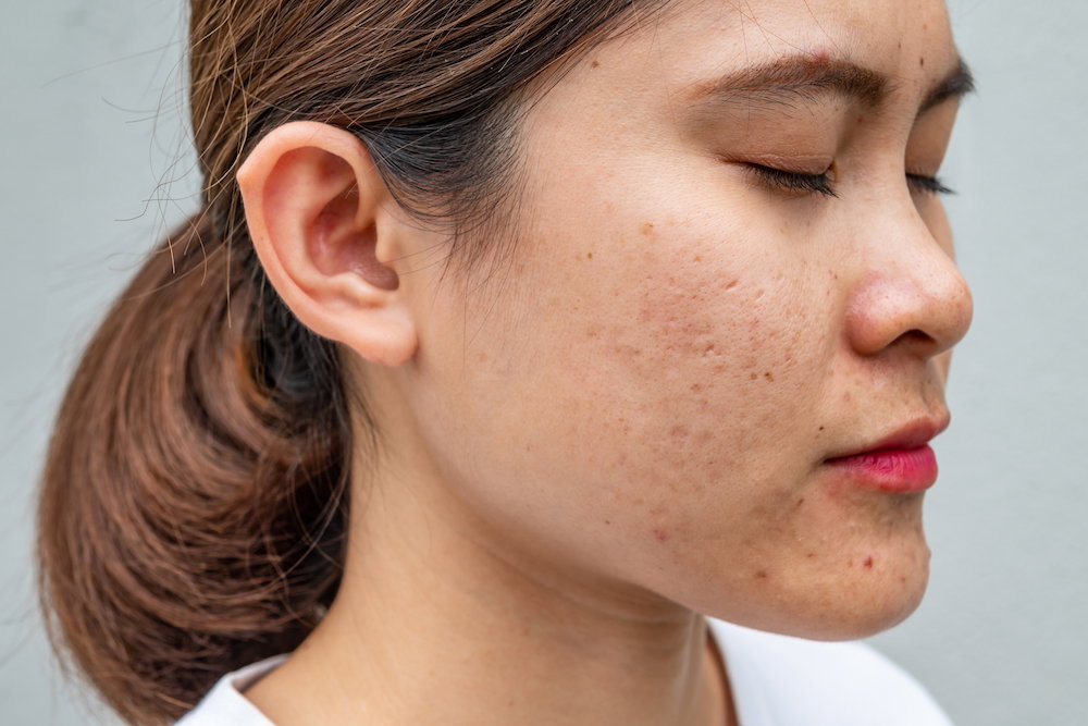 Side view close-up of Asian woman face has variety problems on her skin (such as Acne, Pimple, Pores and Melasma etc).