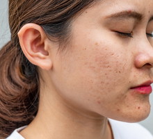 Side view close-up of Asian woman face has variety problems on her skin (such as Acne, Pimple, Pores and Melasma etc).
