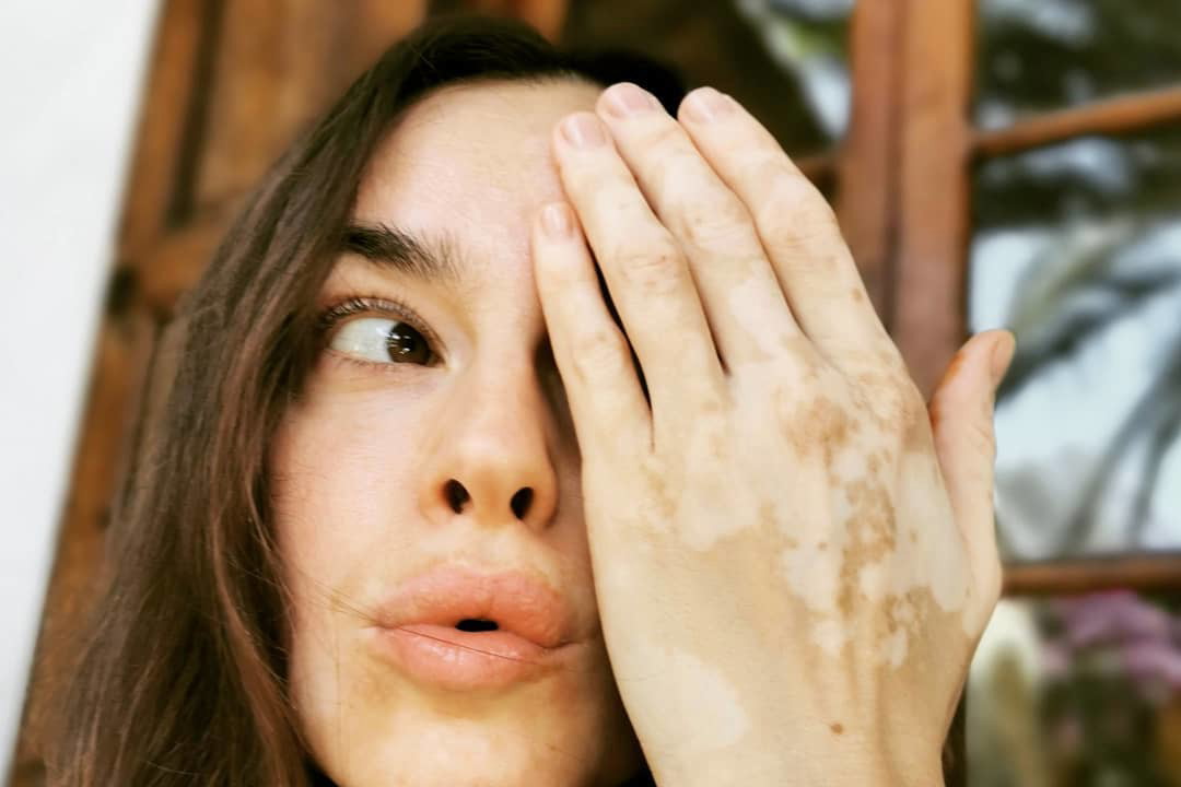 Kasia Smutniak stworzyła filtr na Instagramie, który wspiera osoby z bielactwem