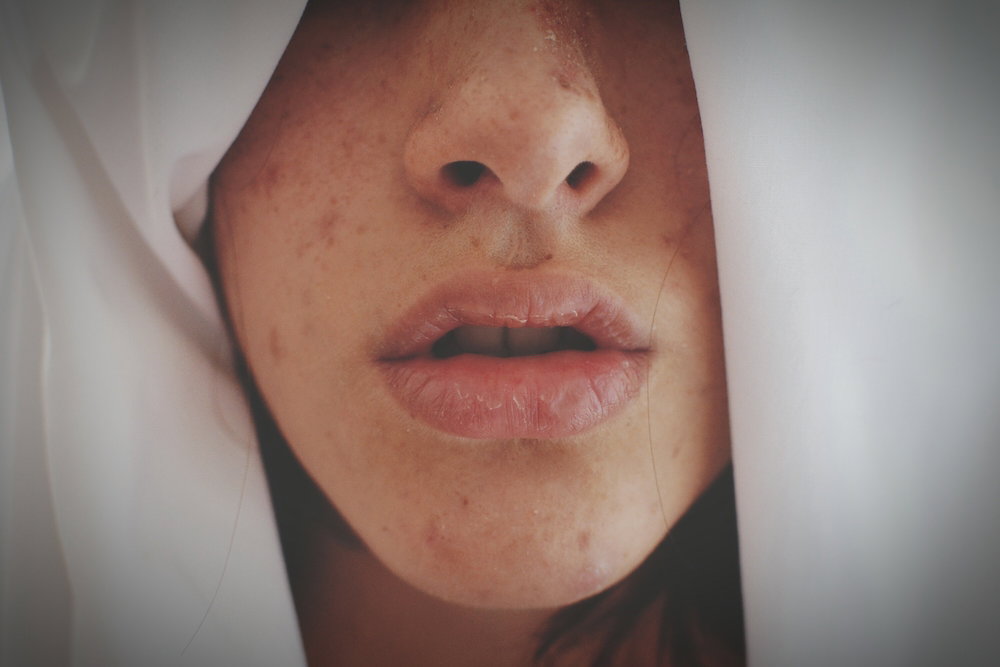 Zaskórniki usuwanie – 5 powodów, dla których nigdy nie powinnaś wyciskać wągrów – tłumaczy dermatolog