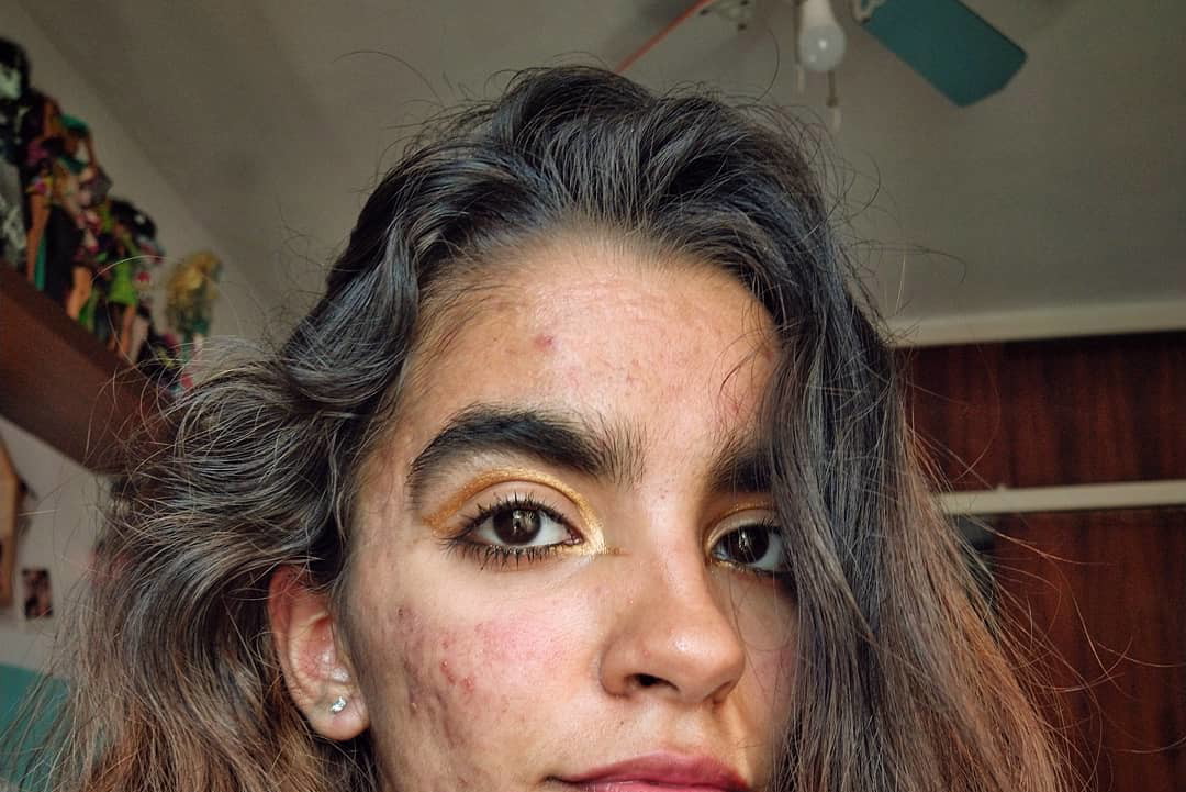 „Usłyszałam, że można się ode mnie zarazić i lepiej mnie nie dotykać” – mówi autorka profilu @skinnoshame, która na Instagramie pokazuje swój trądzik