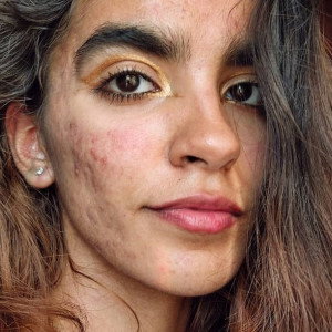 „Usłyszałam, że można się ode mnie zarazić i lepiej mnie nie dotykać” – mówi autorka profilu @skinnoshame, która na Instagramie pokazuje swój trądzik