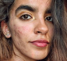 „Usłyszałam, że można się ode mnie zarazić i lepiej mnie nie dotykać” – mówi autorka profilu @skinnoshame, która na Instagramie pokazuje swój trądzik