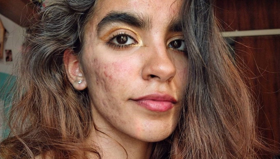 „Usłyszałam, że można się ode mnie zarazić i lepiej mnie nie dotykać” – mówi autorka profilu @skinnoshame, która na Instagramie pokazuje swój trądzik