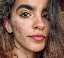 „Usłyszałam, że można się ode mnie zarazić i lepiej mnie nie dotykać” – mówi autorka profilu @skinnoshame, która na Instagramie pokazuje swój trądzik