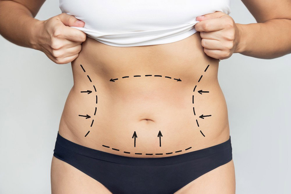 Liposukcja infradźwiękowa