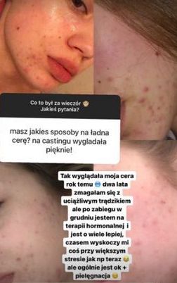Weronika Zoń pokazała zdjęcia z trądzikiem.