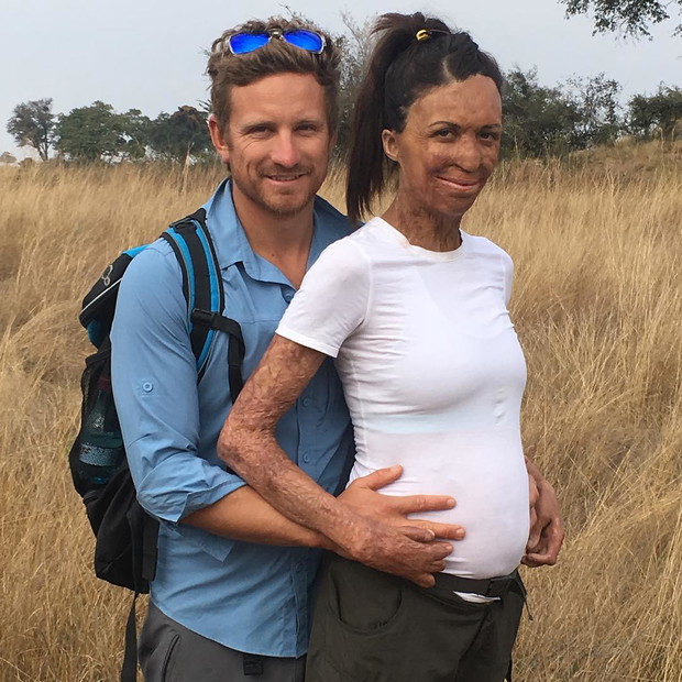 Turia Pitt