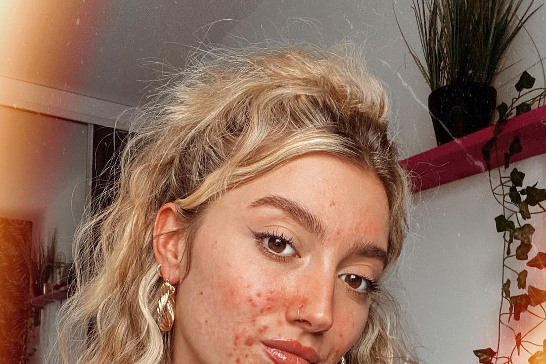 Izzie Rodger, modelka z trądzikiem w reklamie znanej marki. "Gdzie były takie modelki, kiedy dorastałam"?