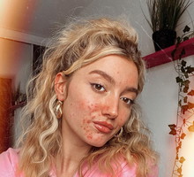 Izzie Rodger, modelka z trądzikiem w reklamie znanej marki. "Gdzie były takie modelki, kiedy dorastałam"?