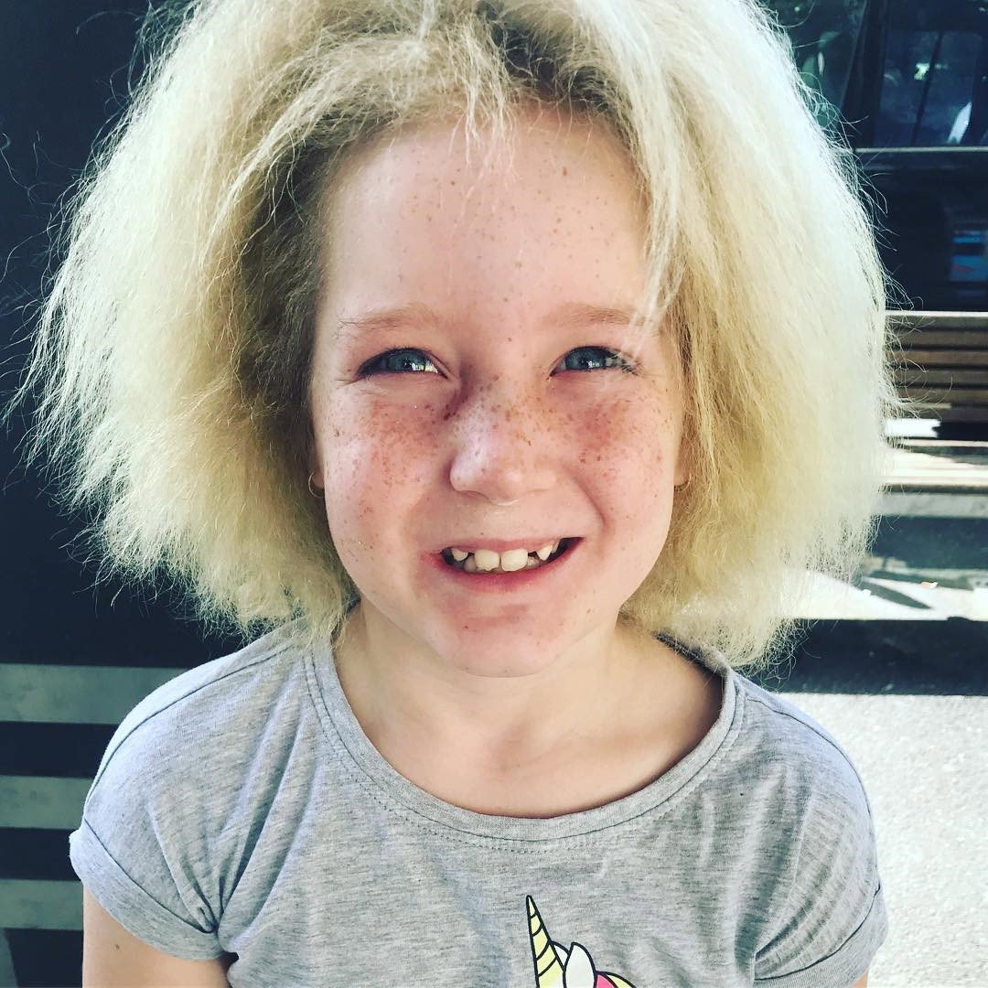 U tej dziewczynki rozpoznano "zespół włosów niedających się uczesać". Mało kto z nas słyszał o takim terminie. Wyjaśniamy, na czym to polega