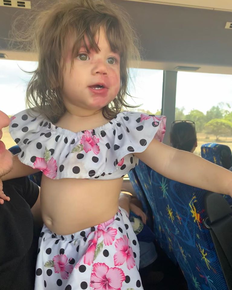 Dziewczynka ze znamionami na twarzy zwanymi "plamami z wina porto"