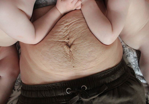 Brzuch po porodzie