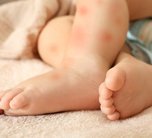 Choroba meningokokowa rozwija się błyskawicznie