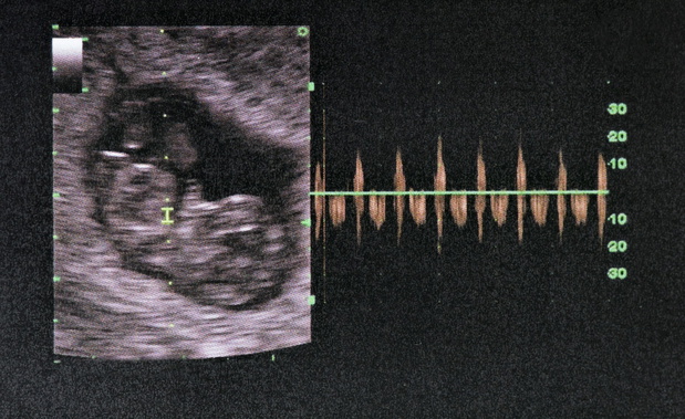 picture of Ultrasound of baby in mother's womb. 24 week.