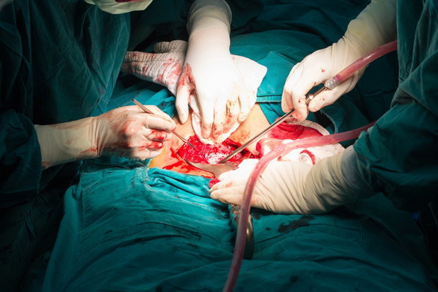 cesarean