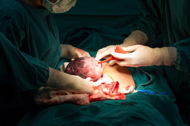 cesarean