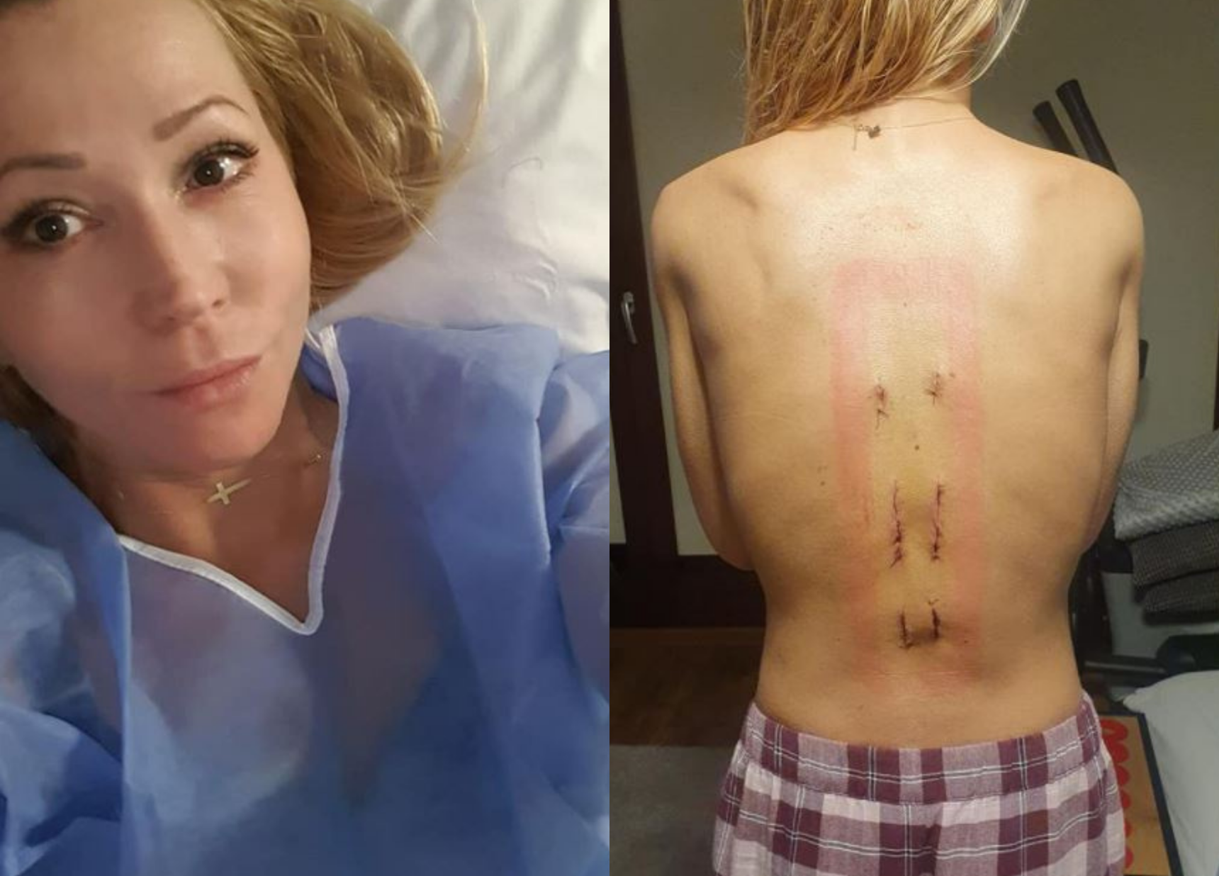 Chłopiec spowodował wypadek na stoku? Kobieta złamała kręgosłup…