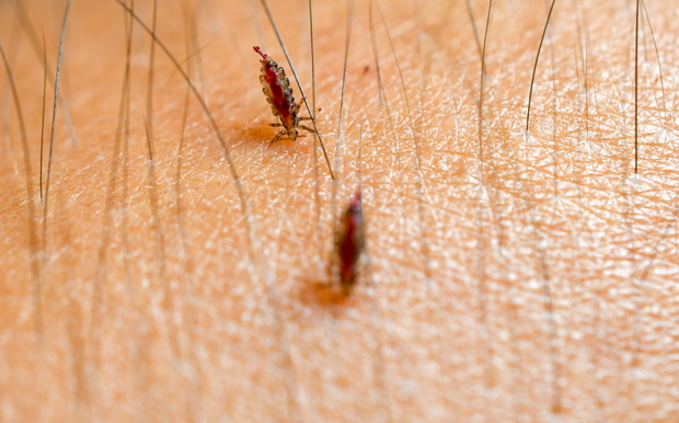 Louse, Head lice feed on blood on human skin.