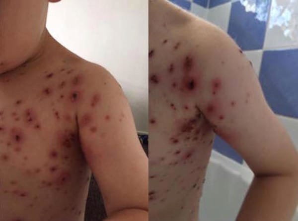 NIebezpieczny ibuprofen dla dzieci z ospą wietrzną