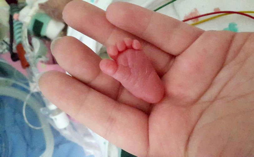 Stópka Emilki Grabarczyk, najmniejszego noworodka świata