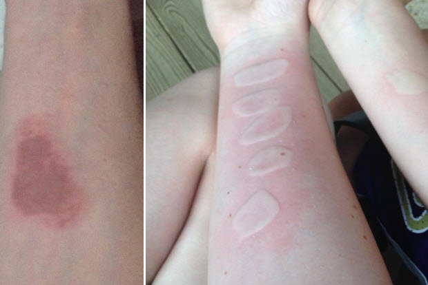 Salt and ice challenge - poparzenia