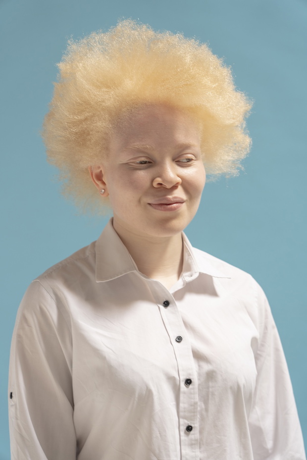 Studio portrait of albino woman in white shirt