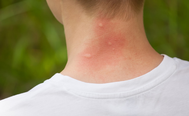 mosquito bites on the neck.