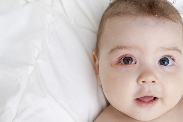 An infant with soured eyes suffers from conjunctivitis