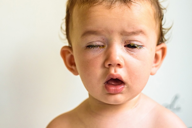 Eyes of a baby with bacterial purulence conjunctivitis.
