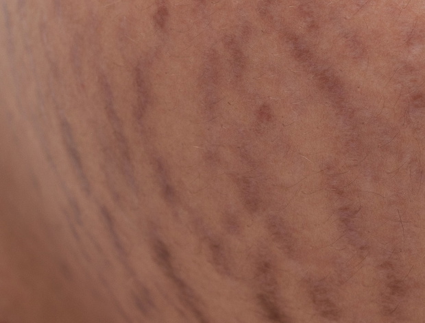 stretch marks on belly