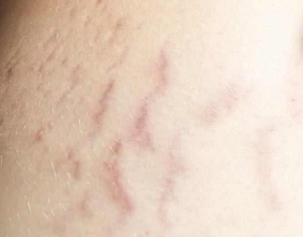 Fresh stretch marks on thigh of a pregnant caucasian woman. Cosm