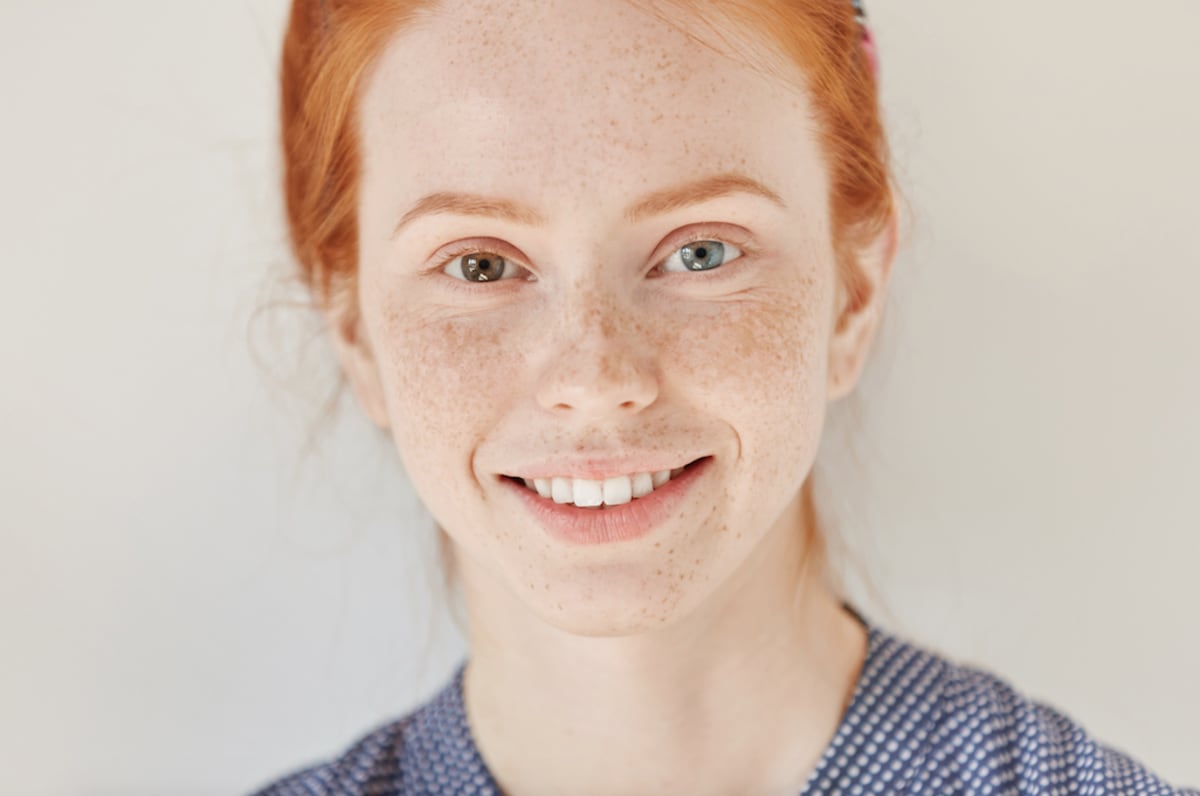 heterochromia