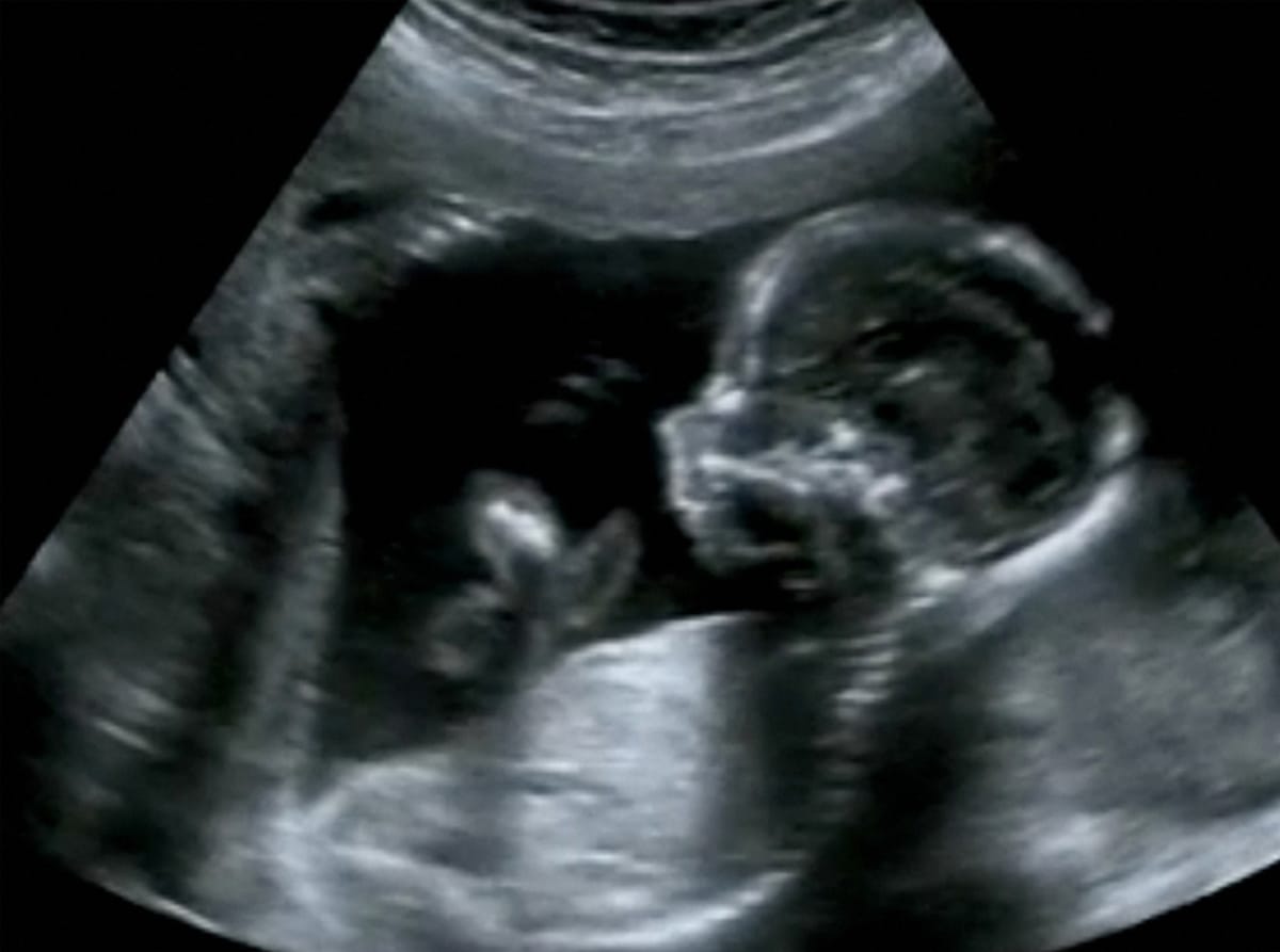 fetus in fetu