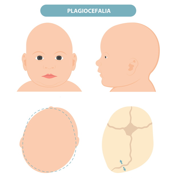 craniosynostosis helmet pillow flat head autism brain skull bone