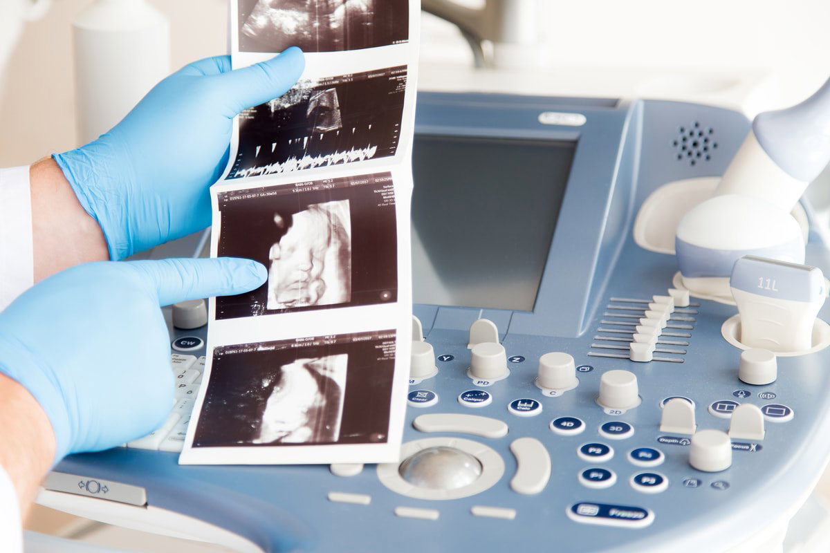 USG prenatalne