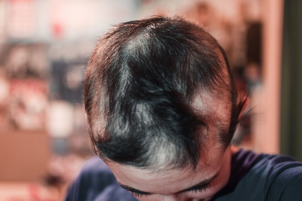Una mujer joven con la enfermedad de alopecia areata muestra var
