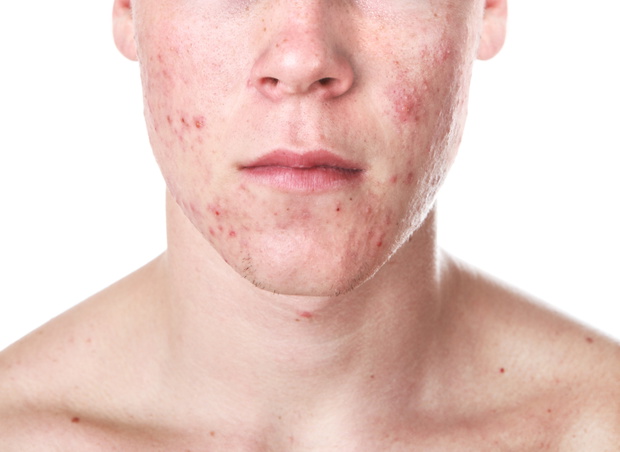 Teenager with Acne