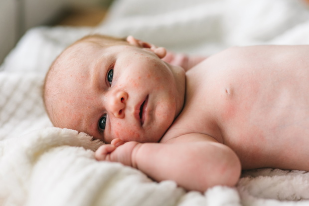 Baby acne, small red and purulent inflammations on the skin of t