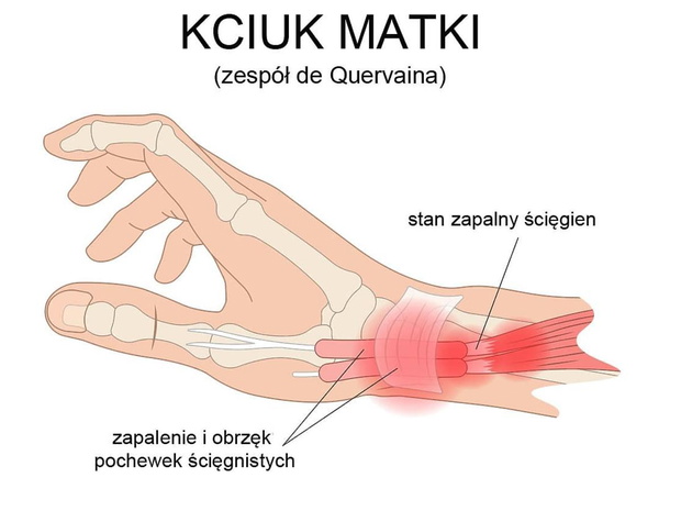kciuk-matki-zespol-de-quervaina-125248-43-4562c97