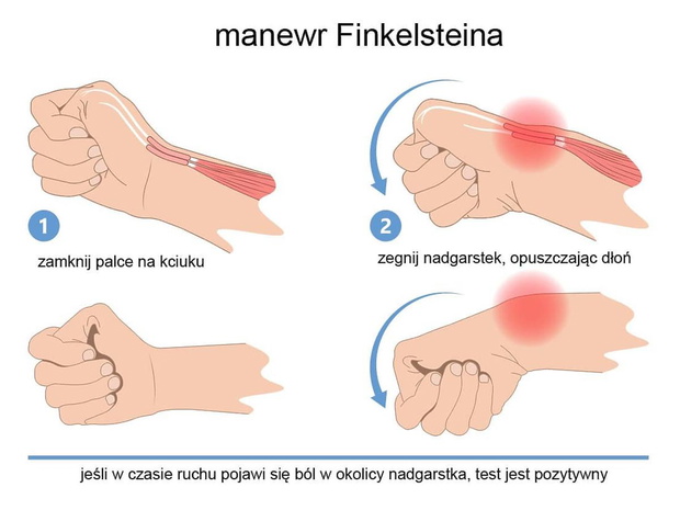 manewr-finkelsteina-125249-43-5ecb541