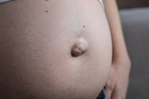 Umbilical hernia in a pregnant woman. Closeup