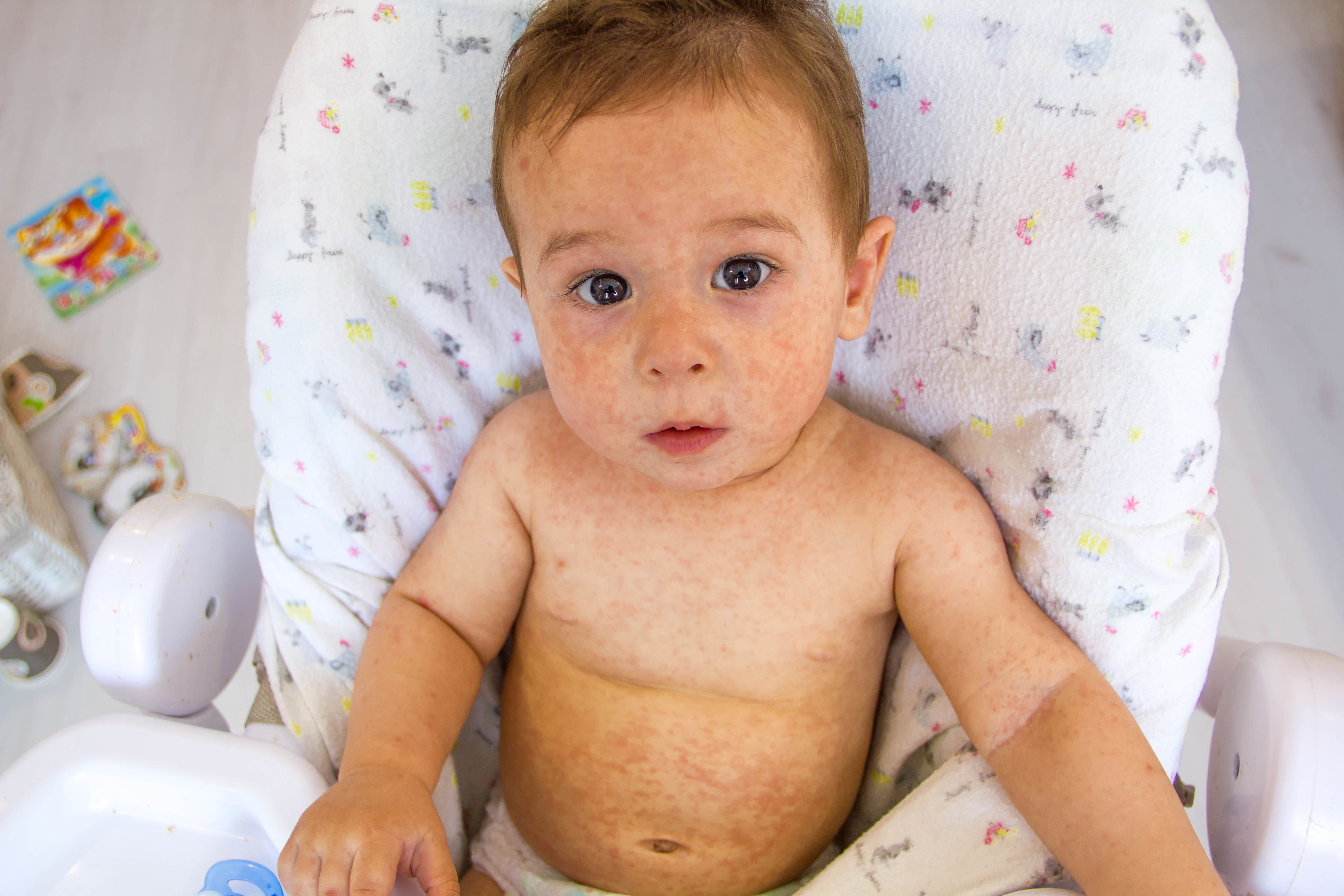 alergia, alergia skórna u dziecka