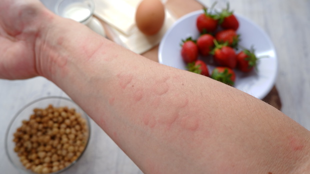 pokrzykwka alergia pokarmowa