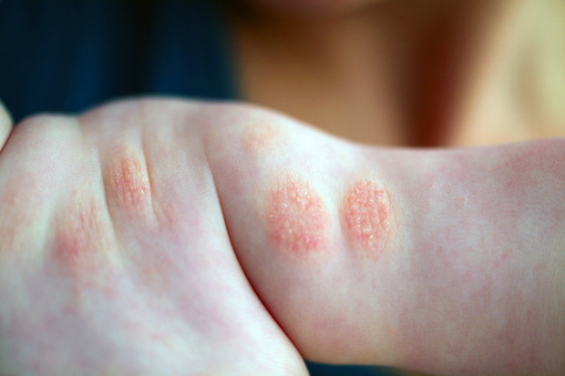 Atopic dermatitis in a child