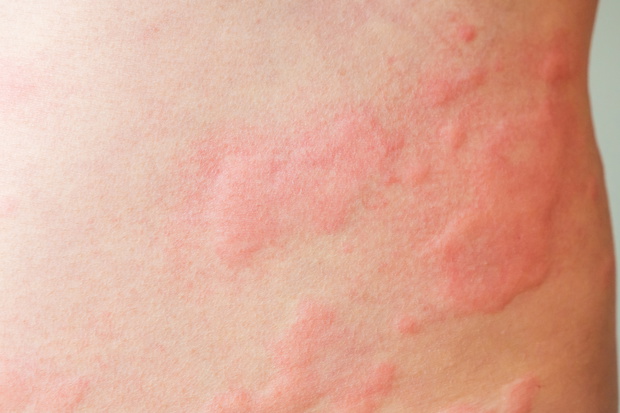 alergia kontaktowa pokrzywka wysypka u dziecka